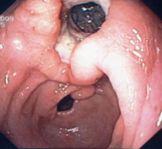Abbildung 2: Transgastraler Zugang zur Bauchspeicheldrüse. Unten ist der Magenausgang zu sehen, oben der geschaffene, große Zugang zur Bauchspeicheldrüse (transgastral)