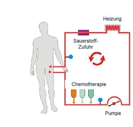 Abbildung 1: Schematische Darstellung der hyperthermen Extremitätenperfusion. Nach Isolierung des Beines erfolgt die Perfusion des Beines mit einer Herz-Lungen-Maschine.