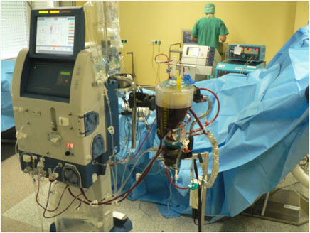 Abbildung 2: Extremitätenperfusion am Bein: Das Bein wird über eine Herzlungenmaschine mit Medikamenten durchströmt und überwärmt.