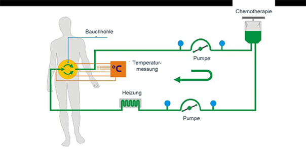 Schematische Darstellung der hyperthermen intraperitonealen Chemotherapie (HIPEC) 