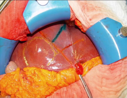 Abbildung 3: Lebersitus mit onographie-gestützter Markierung von anatomischen Gefäßverläufen und geplanter Resektionslinie.