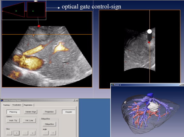 Abbildung 2: Intraoperative Visualisierung von 3D-Ultraschall-Daten. Zur Fokussierung der Tumorgrenzen ist die transversale Ebene (rote Linie und roter Rahmen) im Tumorzenit fixiert (a). Zur Fokussierung eines Gefäßverlaufes wurde die transversale Ebene in den Gefäßverlauf gekippt (b). Die sagittale Ebene ist an die Position der Instrumentenspitze gekoppelt. 