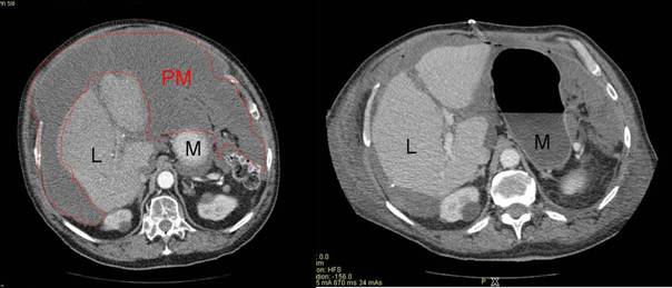 Abbildung 2 : Computertomographie mit einem ausgedehnten Pseudomyxoma peritionei (PM) mit Verdrängung von Magen (M) und Leber (L) vor und nach operativem Tumordebulking